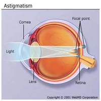 Astigmatism